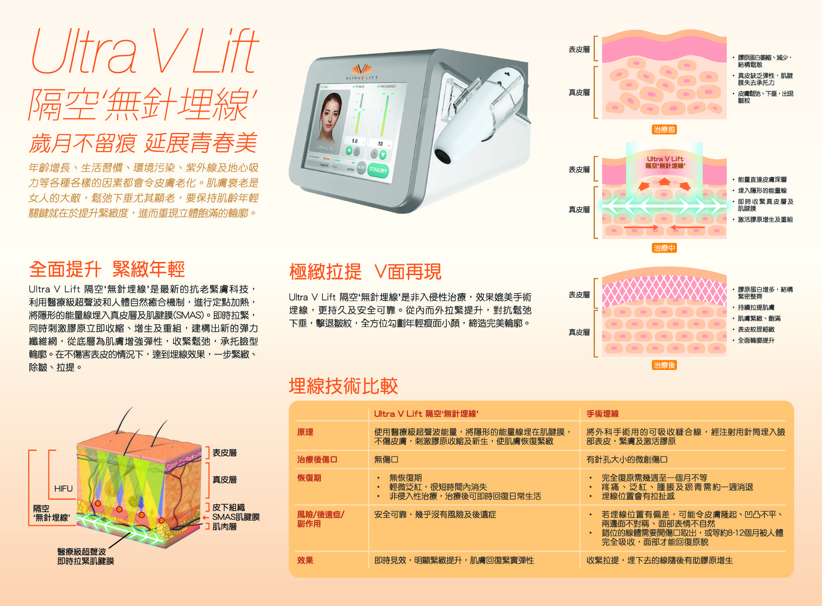 Ultra V Lift